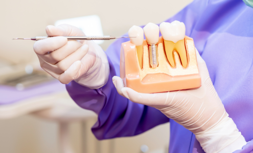 Dental Implants 1 Dental Implants 1