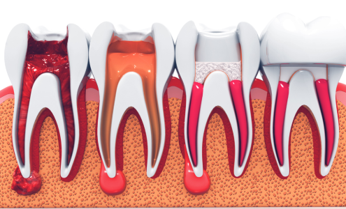 Root Canal Treatment 1