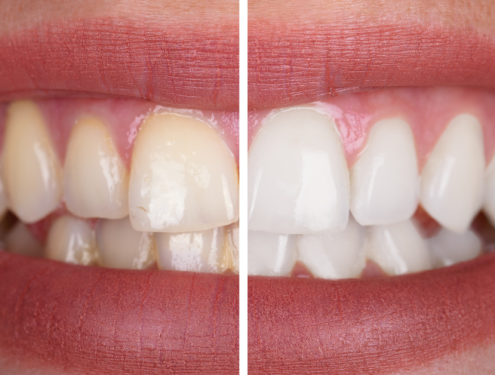 Teeth Whitening 1 Teeth Whitening 1