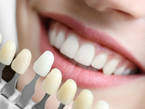 Teeth Whitening 2 Teeth Whitening 2